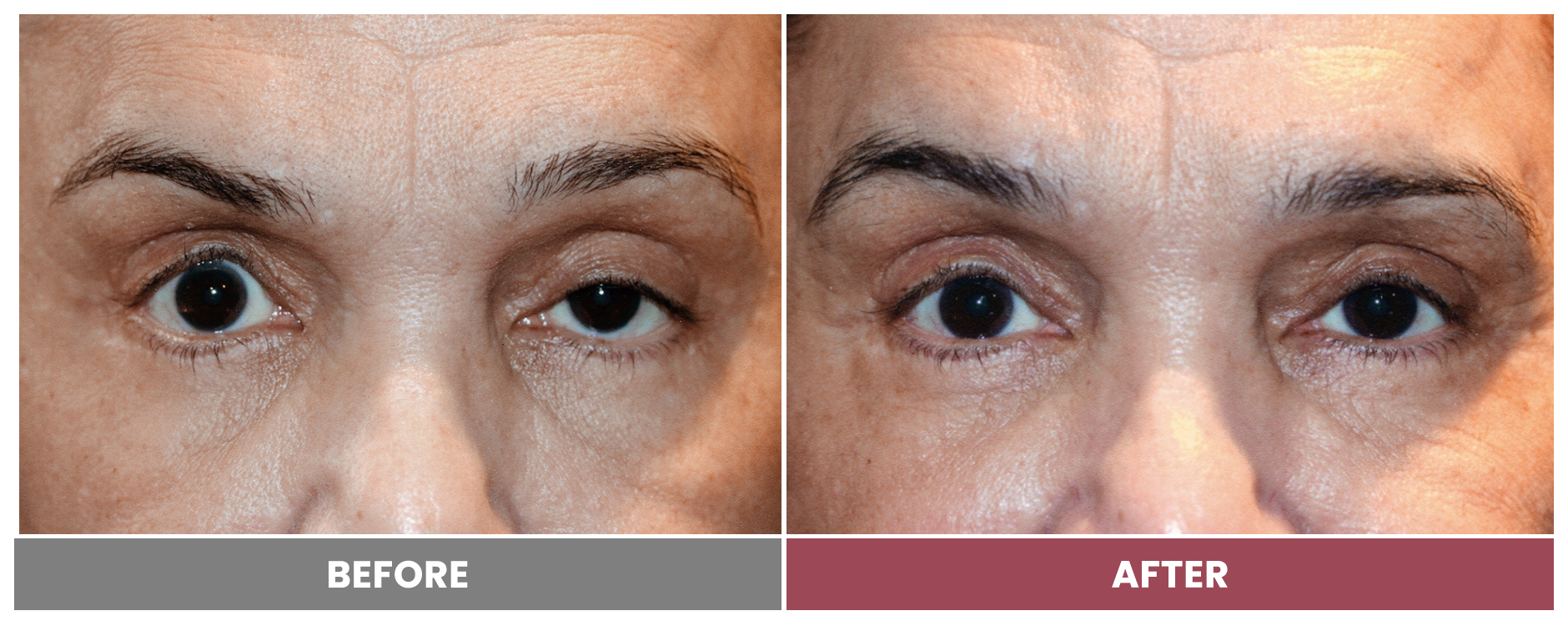PTOSIS REPAIR - Case 54